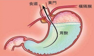 胃酸怎么办 胃酸怎么办 最简单的方法