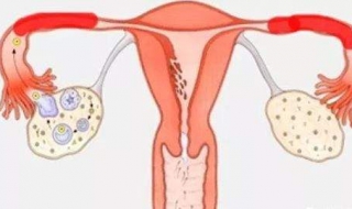 输卵管堵塞怎么办 双侧输卵管堵塞怎么办