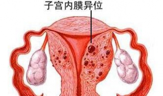 子宫内膜移位怎么办 子宫内膜异位怎么办,严重吗