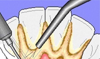 牙结石怎么去除 牙结石去除后牙缝变大怎么办