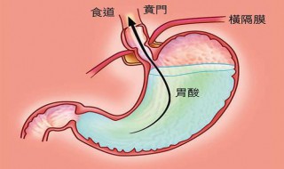 有点胃酸怎么办 有点胃酸怎么办啊