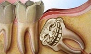 拔完智齿后注意事项 拔完智齿后注意事项与禁忌症
