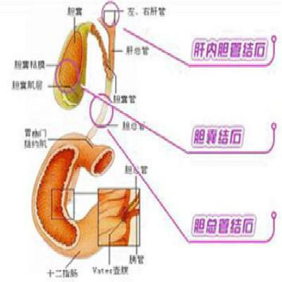 胆囊炎吃什么好（慢性胆囊炎吃什么好）