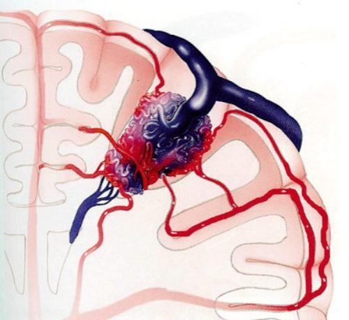 脑动静脉畸形（脑动静脉畸形最常见的症状是）