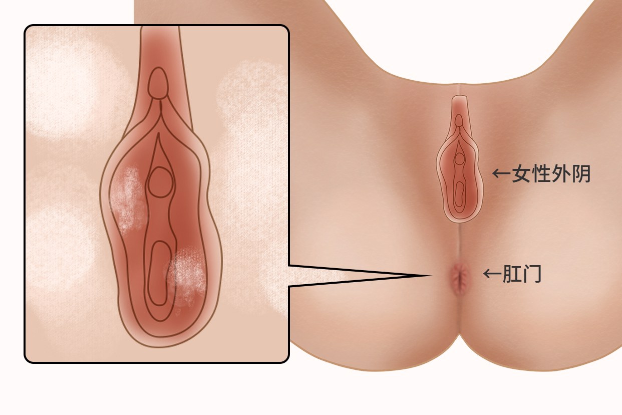 外阴鳞状图片（鳞状上皮图片）