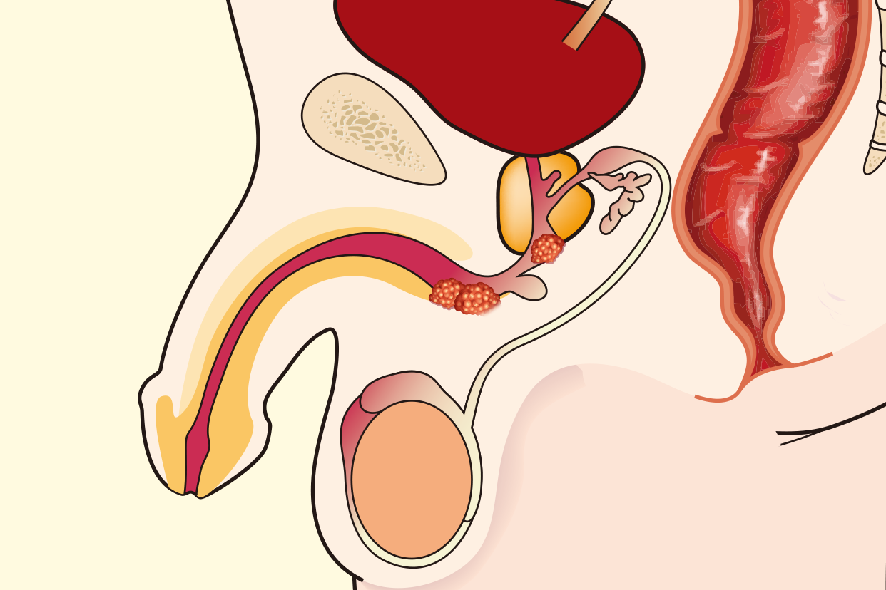 尿道肿瘤图片（男性尿道肿瘤图片）