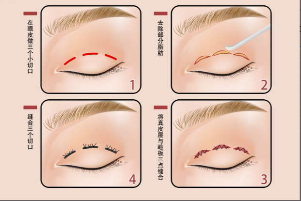 三点微创双眼皮图片（三点微创双眼皮恢复图）