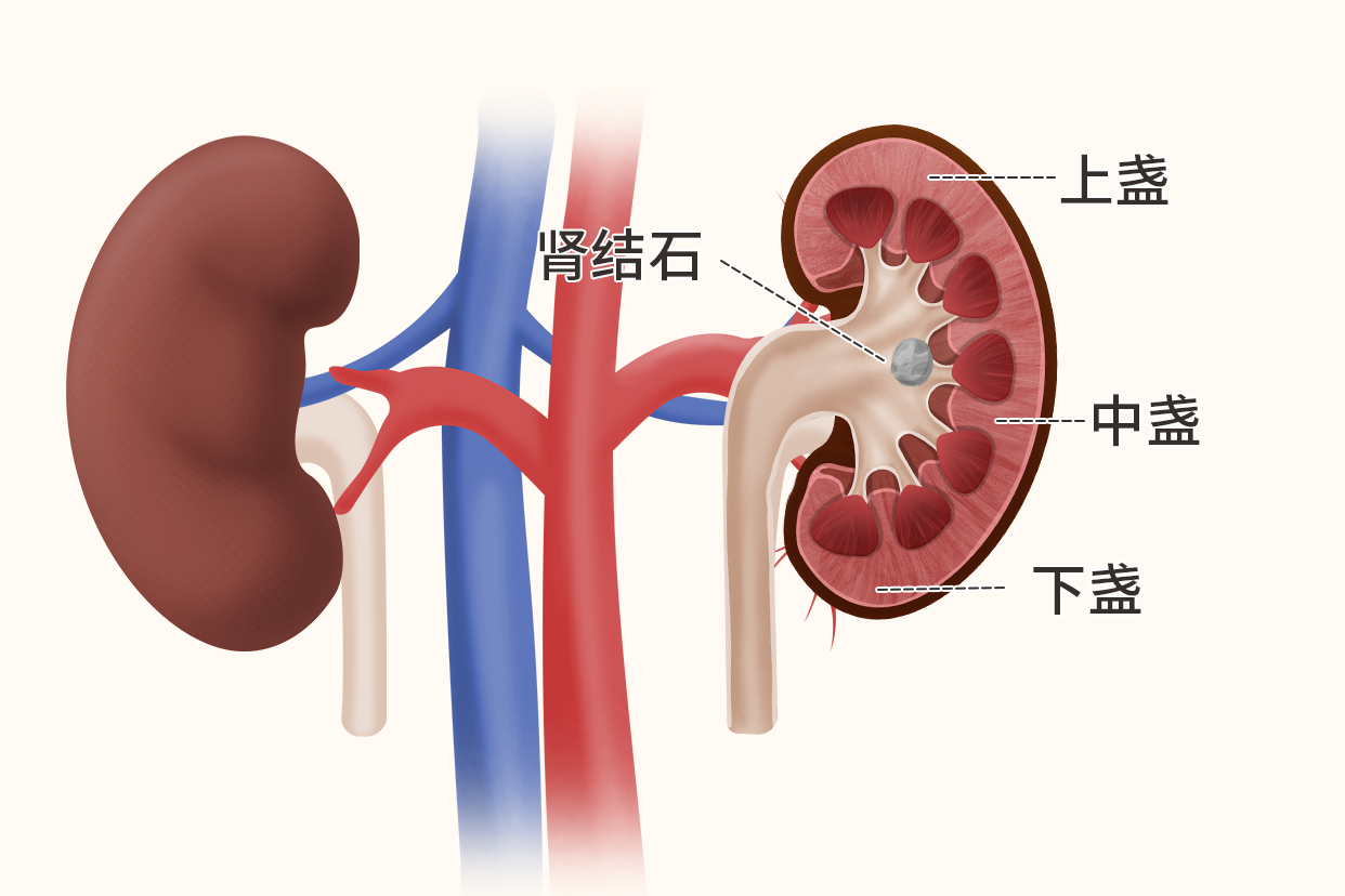 肾中盏结石图片 肾盏结石图片位置示意图