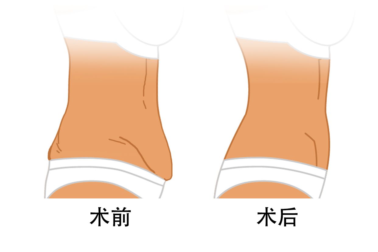 腹壁整形术前后效果图 腹壁整形术前后效果图大全