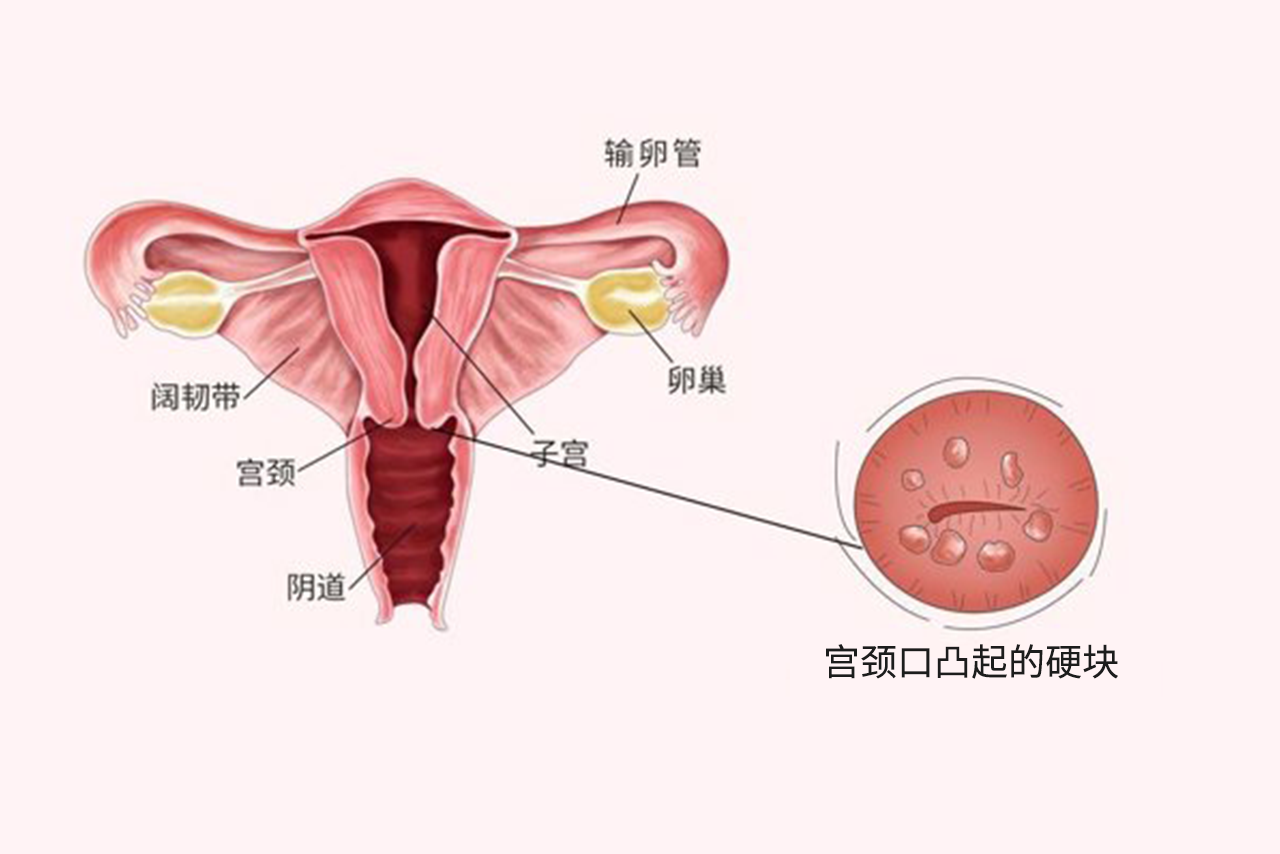 宫颈口摸到凸起硬块不痛不痒图片 宫颈口摸到凸起有疙瘩图片