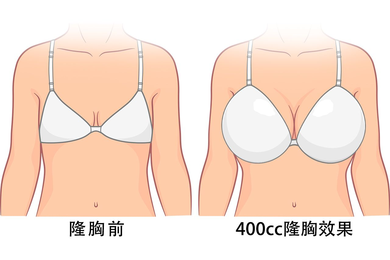 假体隆胸400cc真人图片 假体隆胸400cc真人图片视频