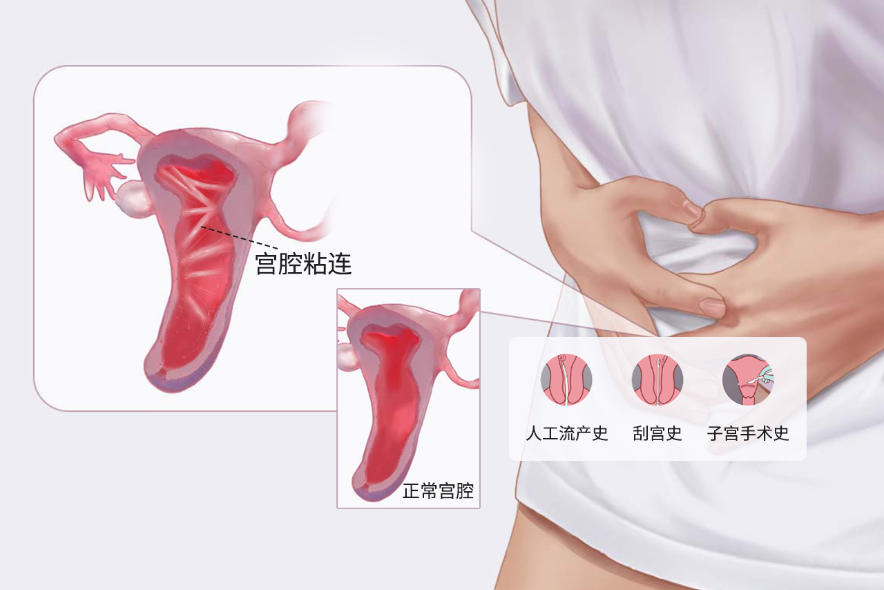 宫腔粘连和正常区别图（宫腔粘连和正常区别图片大全）