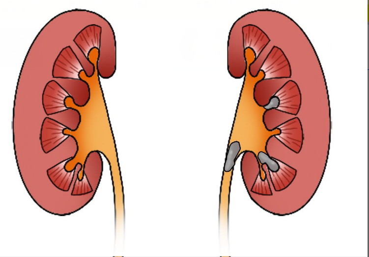 左肾结石图片 右肾结石图片