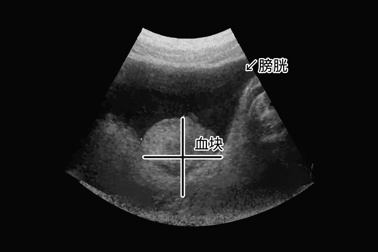 膀胱内血块超声图片（膀胱内血块超声表现）