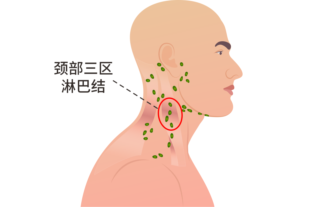 颈部三区淋巴结位置图