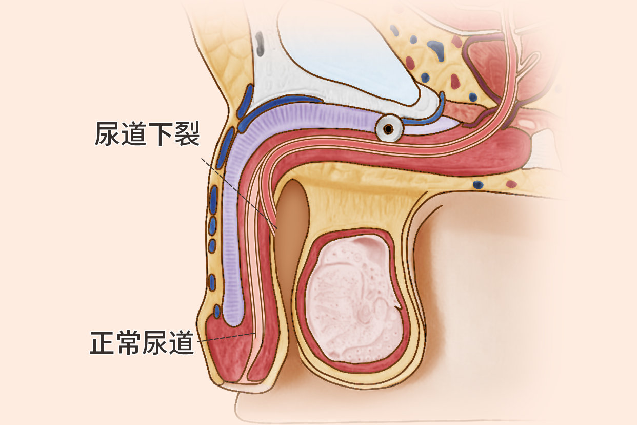 尿道下裂严重程度图片