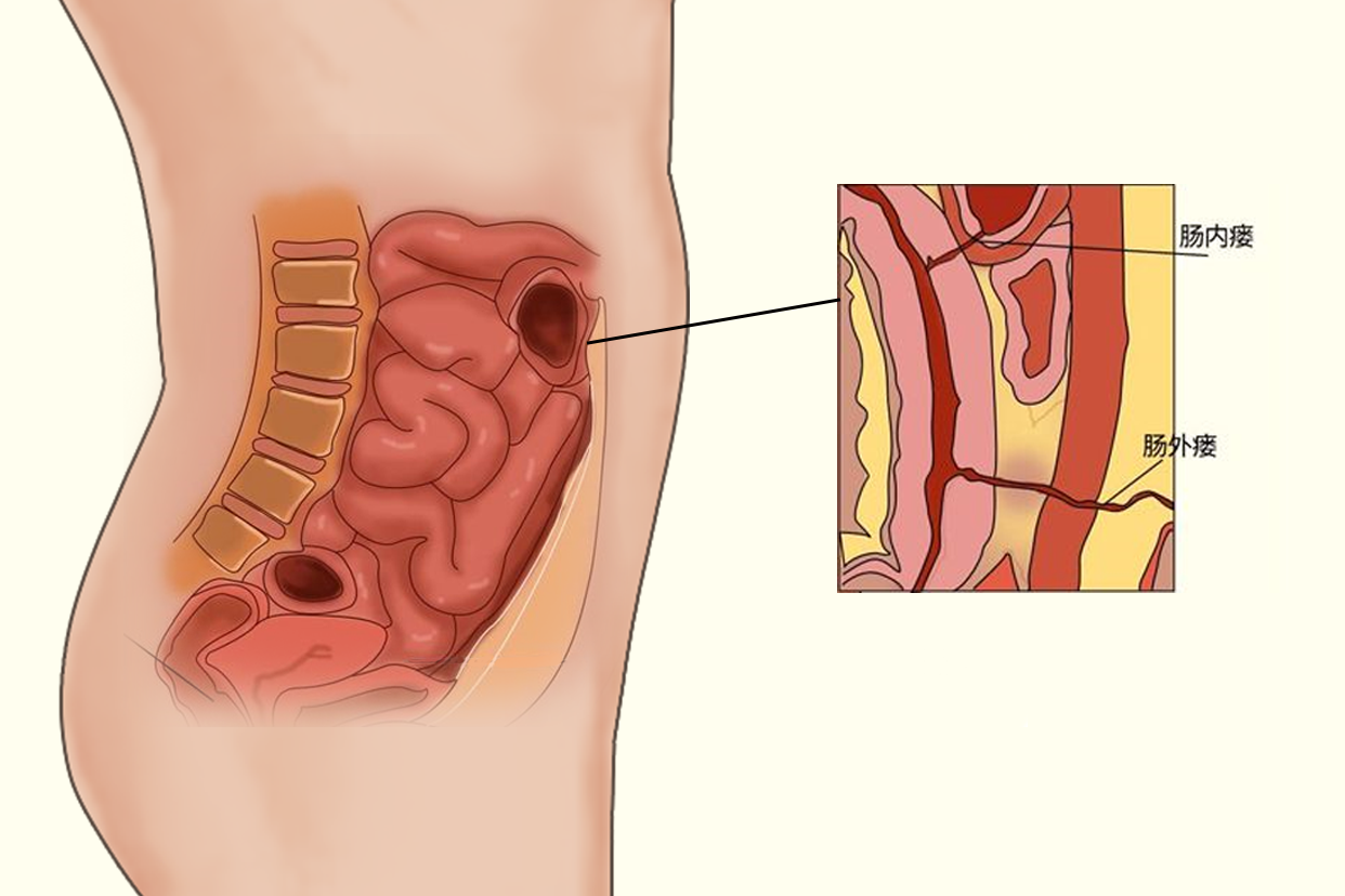 内瘘解剖图（肛瘘解剖图）