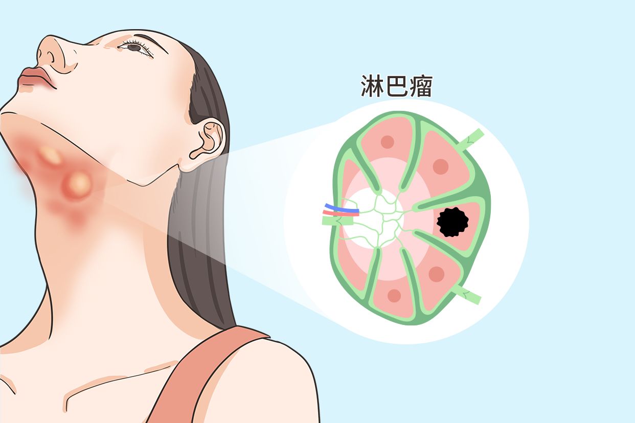 颌下淋巴瘤的图片（颌下淋巴瘤的图片及症状）