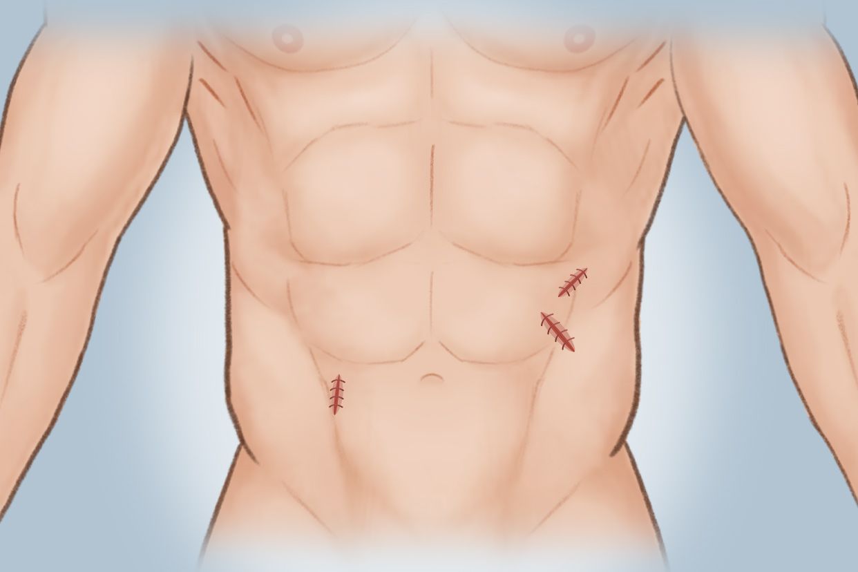 腹部补片手术后图片 腹部手术补片是什么