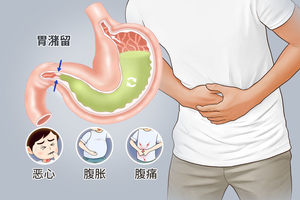 胃潴留图片 胃潴留图片 消化不良