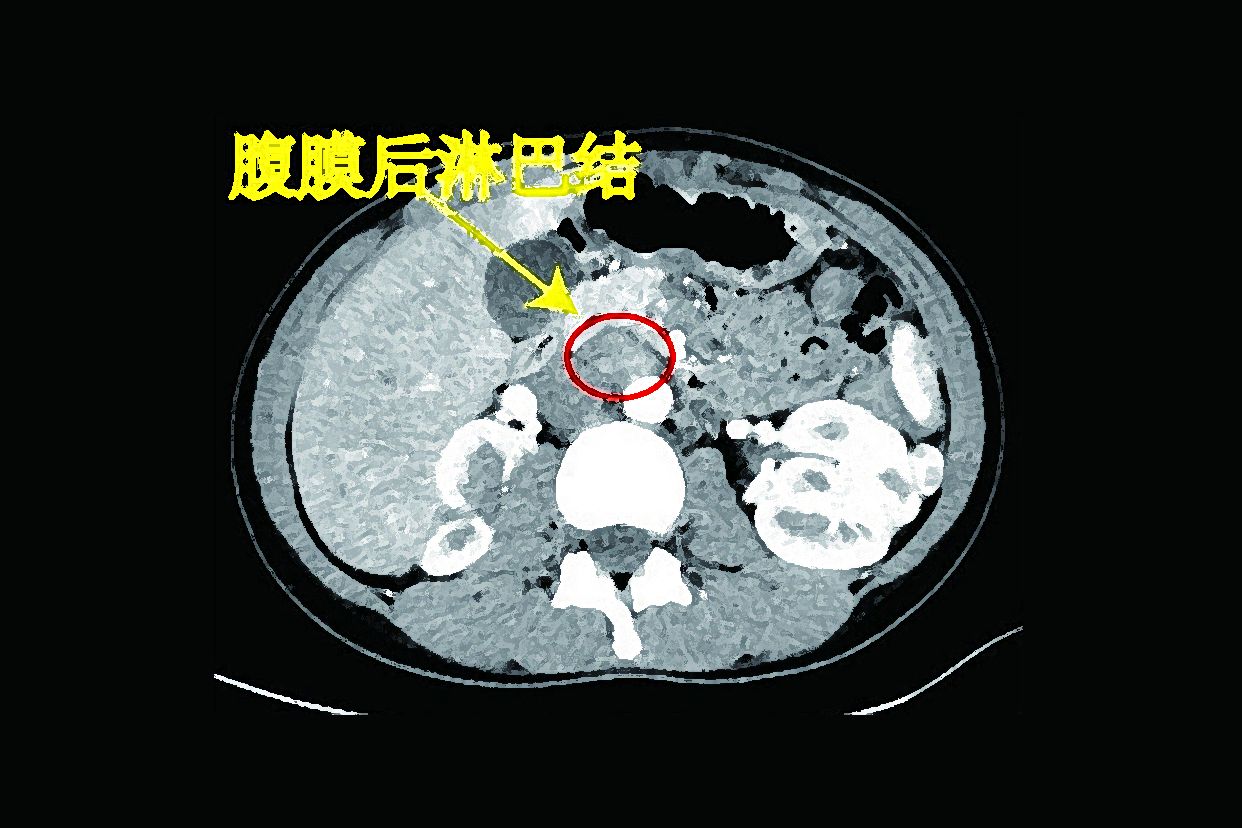 腹膜后淋巴结ct图像（腹膜后淋巴结影像）