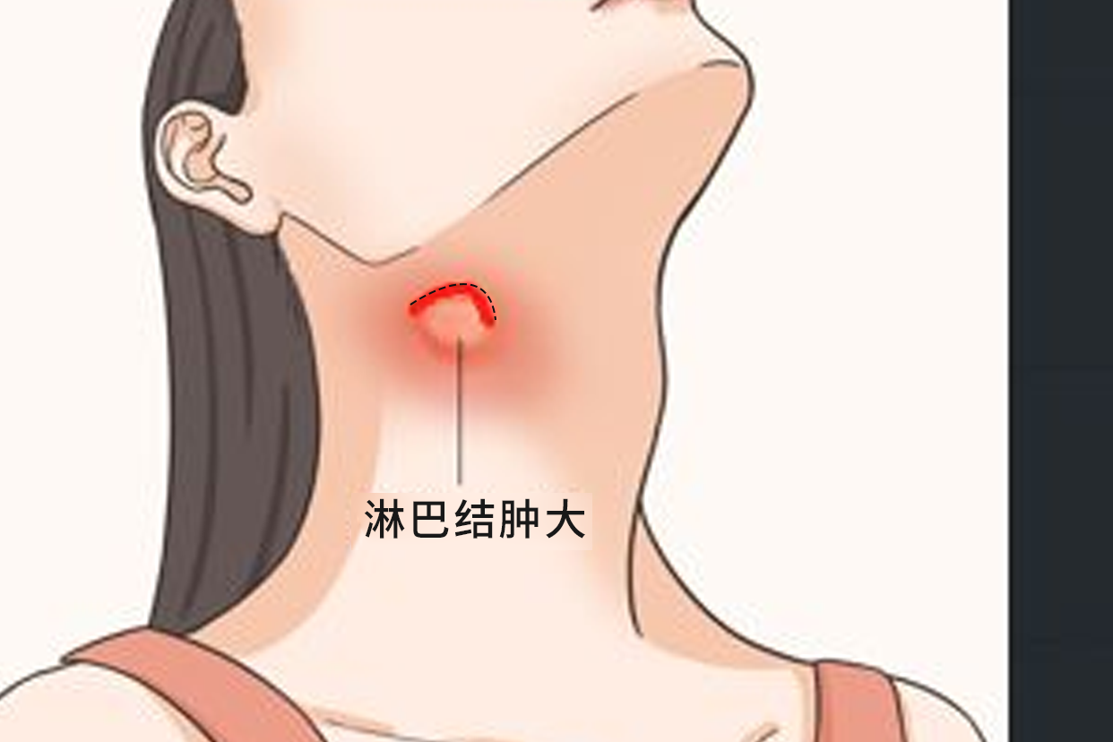 颈部淋巴手术切口图片 颈部淋巴手术切口图片