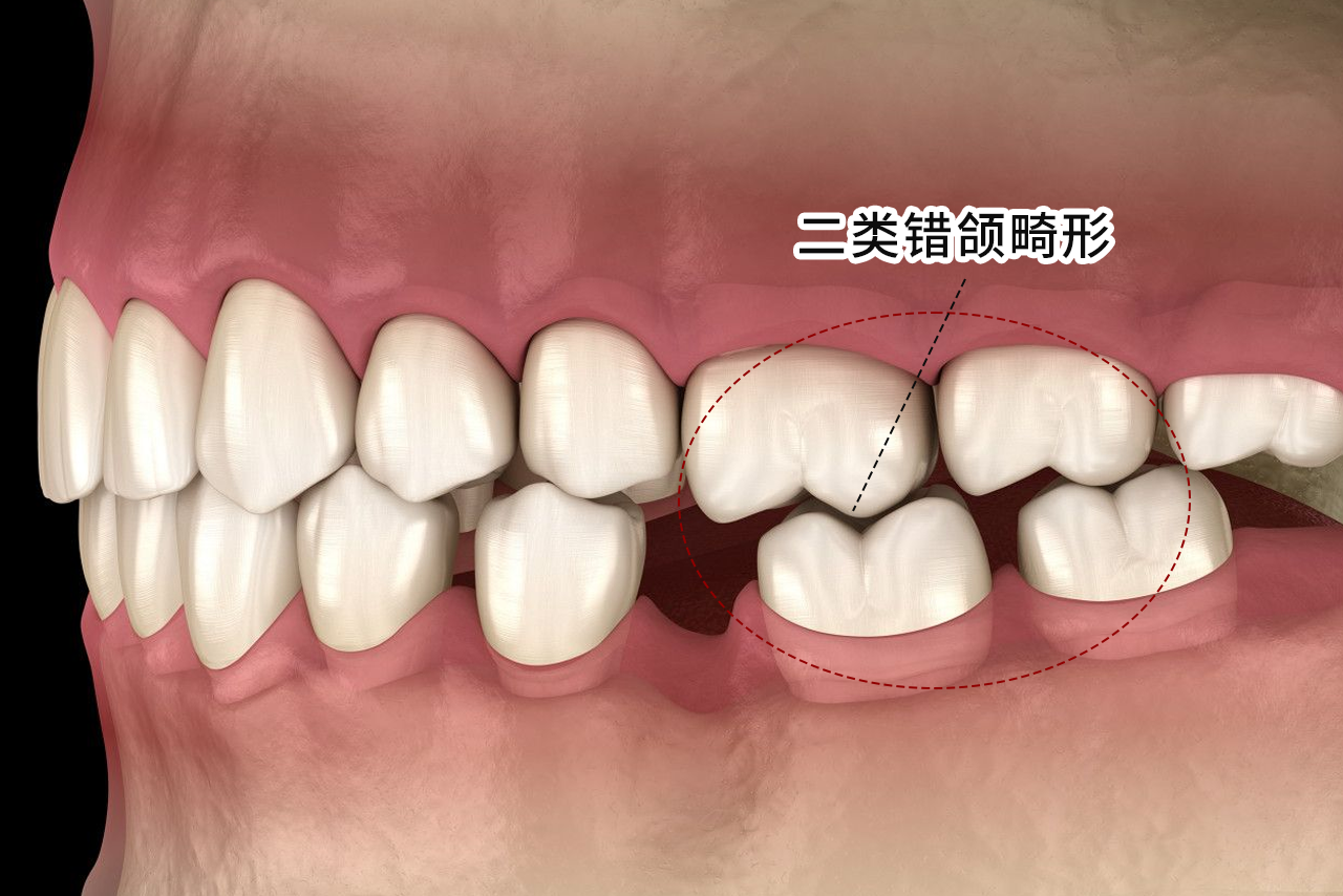 二类错颌畸形图片（安氏二类错颌怎么矫正）