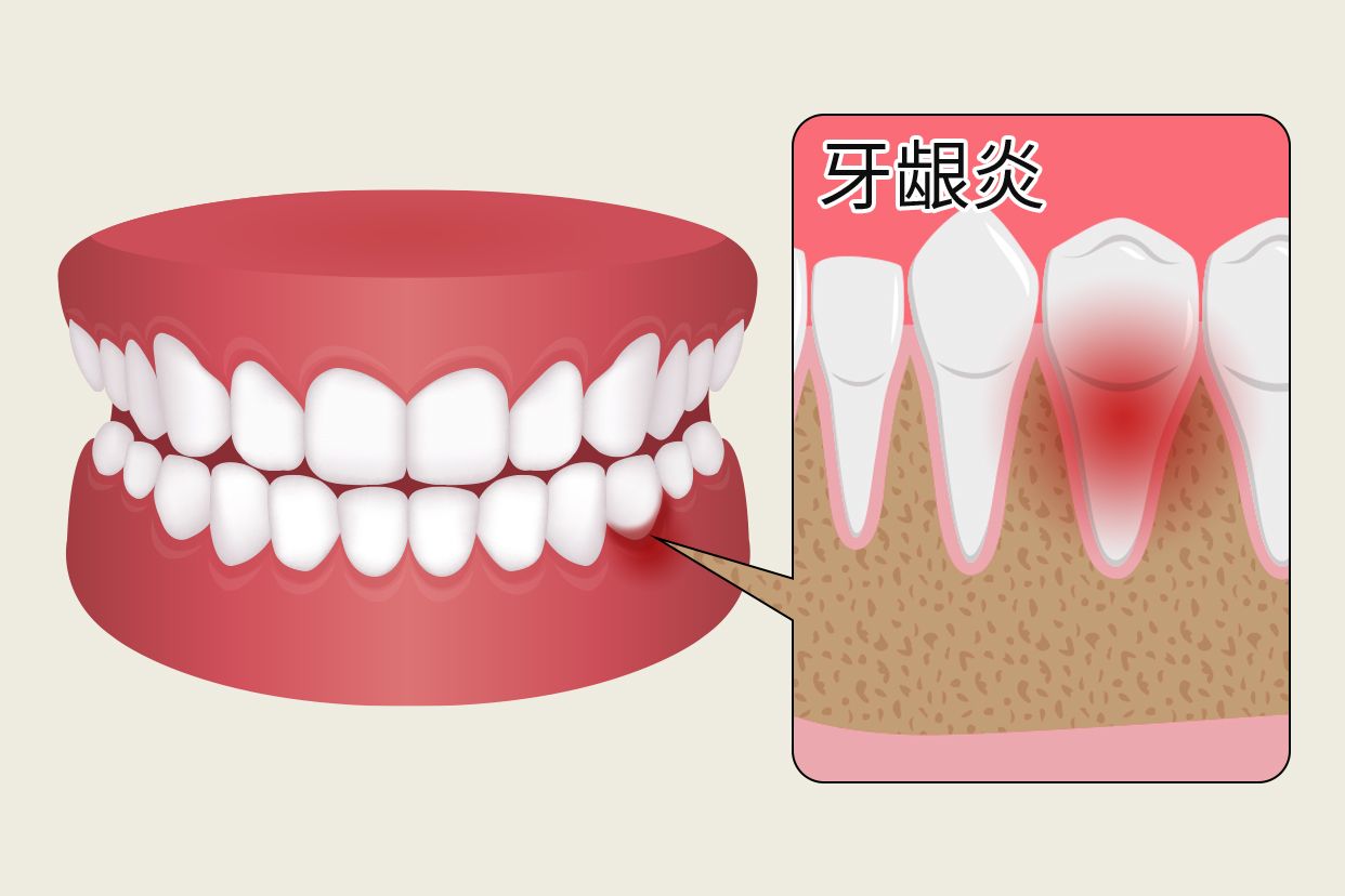 牙龈炎早期症状图片 牙龈炎的症状表现图片