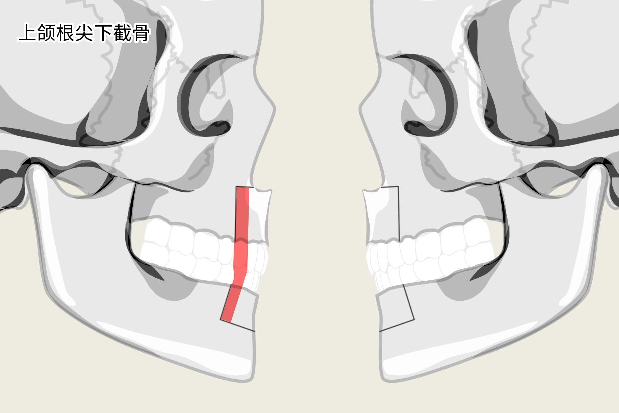 上颌根尖下截骨示意图 上颌根尖下截骨术