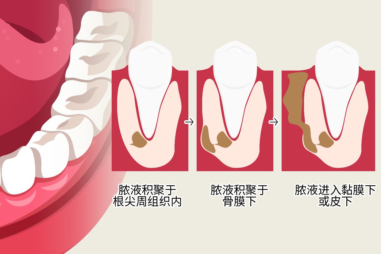 根尖周炎图片全景牙图 牙龈根尖周炎图片