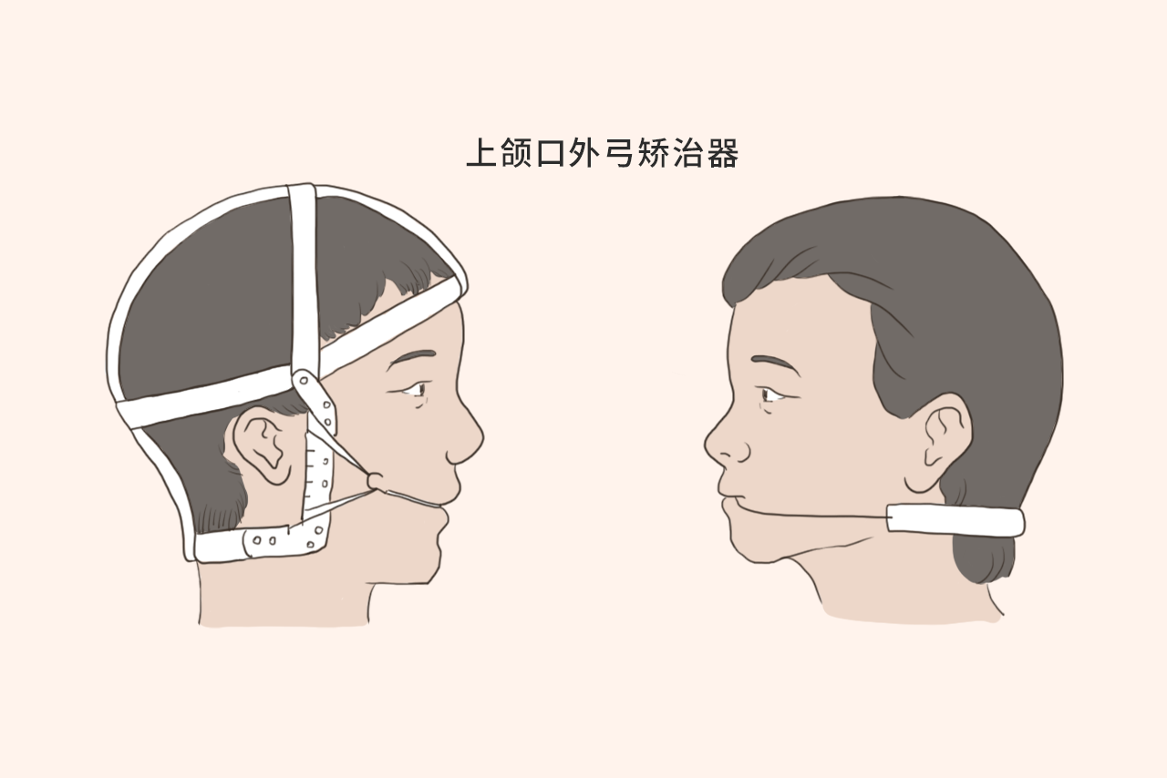 上颌口外弓矫治器图片 上颌口外弓矫治器图片