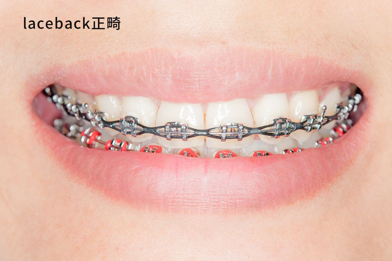 laceback正畸示范图（正畸laceback做法）