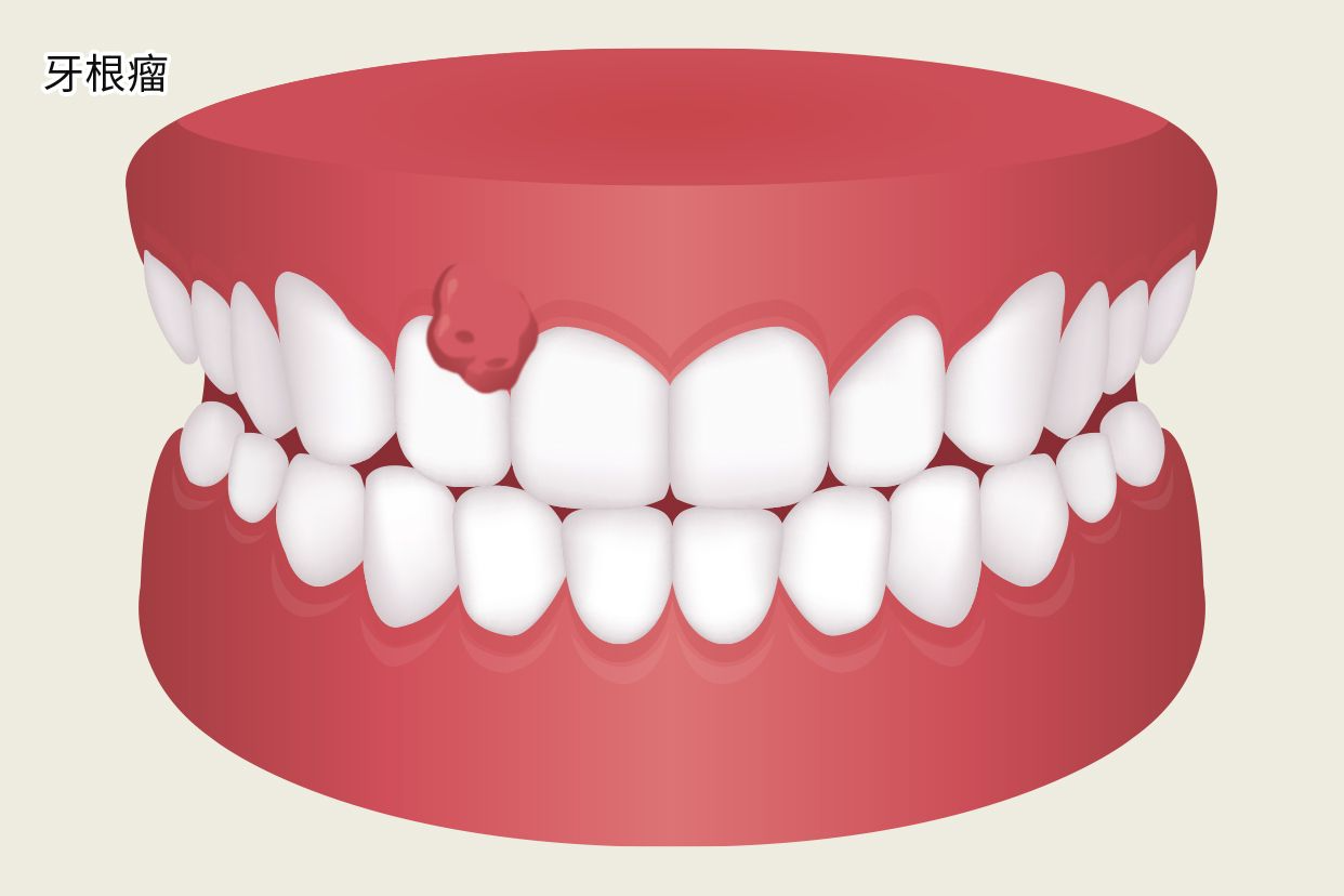 牙根瘤照片 牙本质瘤图片