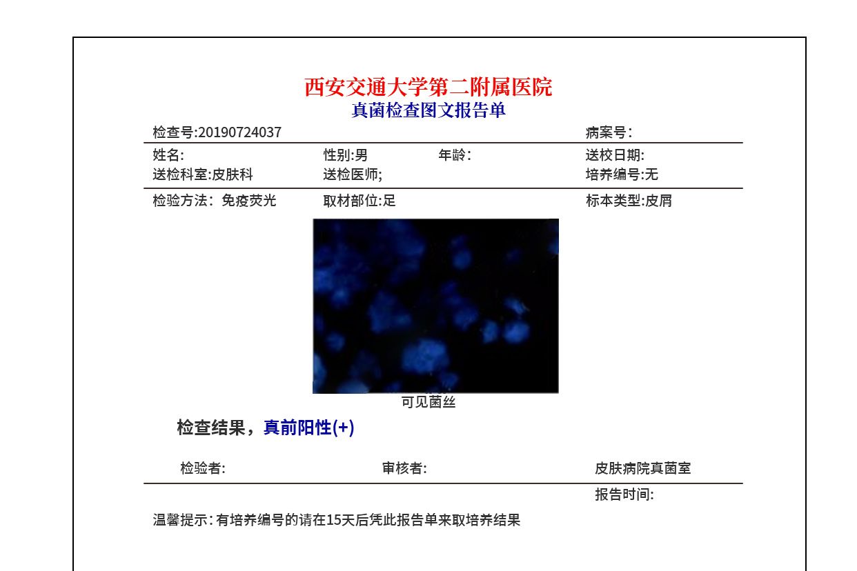 真菌检查报告单图片 真菌检查报告单图片怎么那么脏