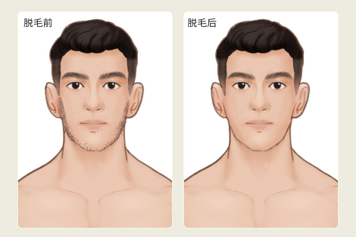 络腮胡子激光脱毛效果图 络腮胡子激光脱毛效果图片