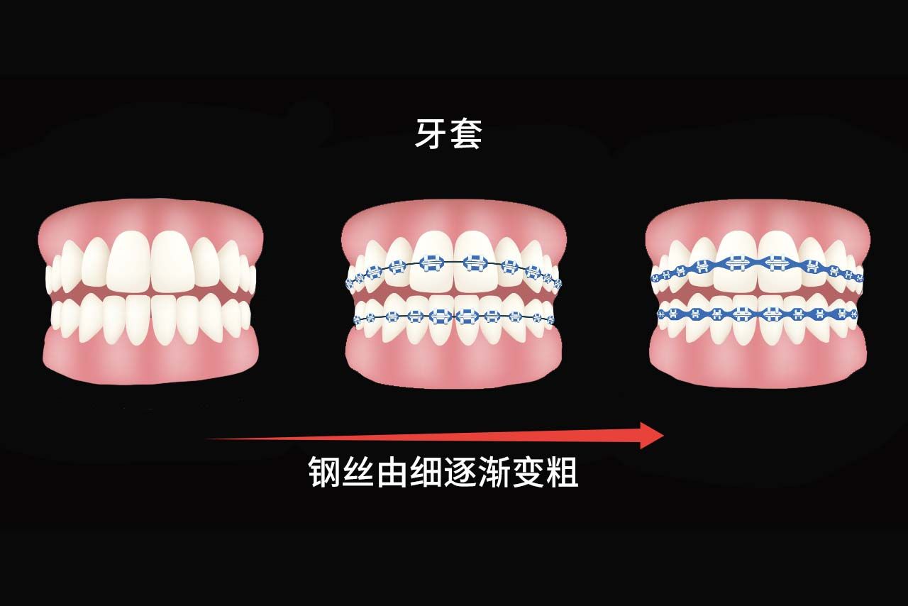 牙套换钢丝粗细顺序图片 牙套换钢丝粗细顺序图片大全