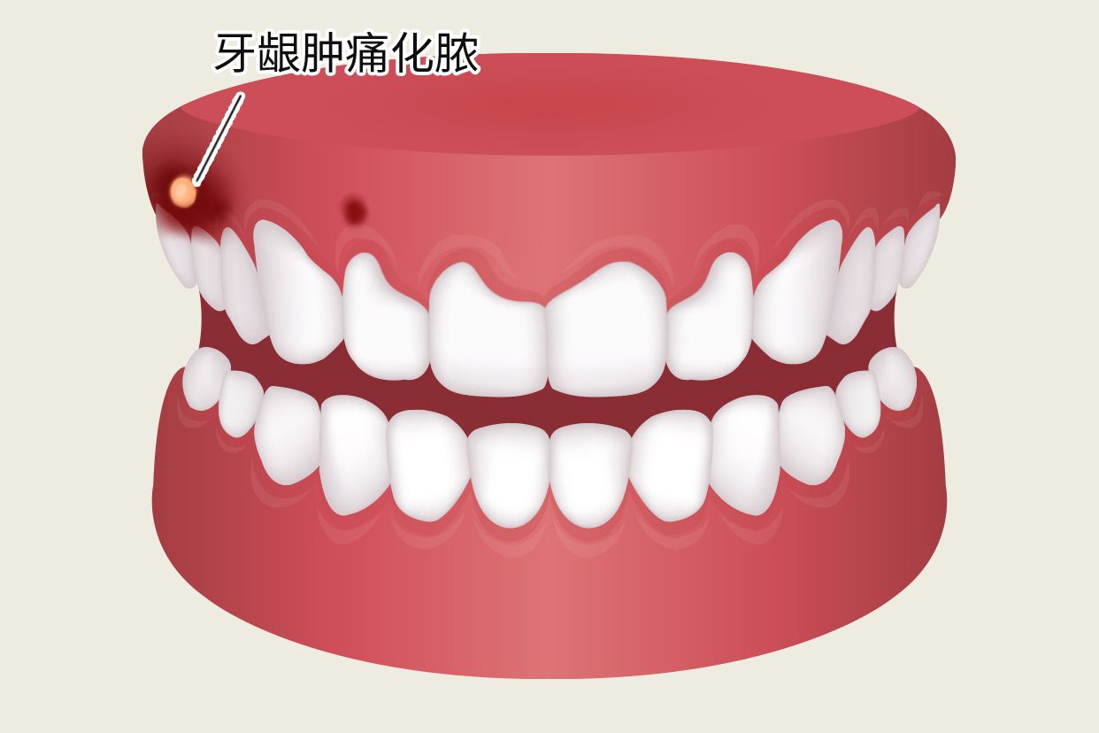 冠周炎牙龈肿痛化脓图片 牙周炎牙龈化脓图片