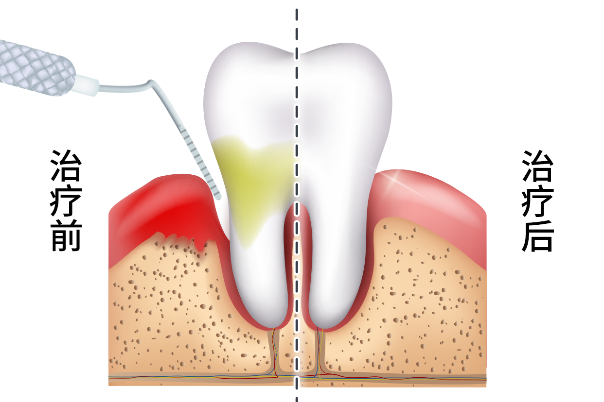 牙周炎牙缝修补效果图 牙周炎牙缝修补效果图片