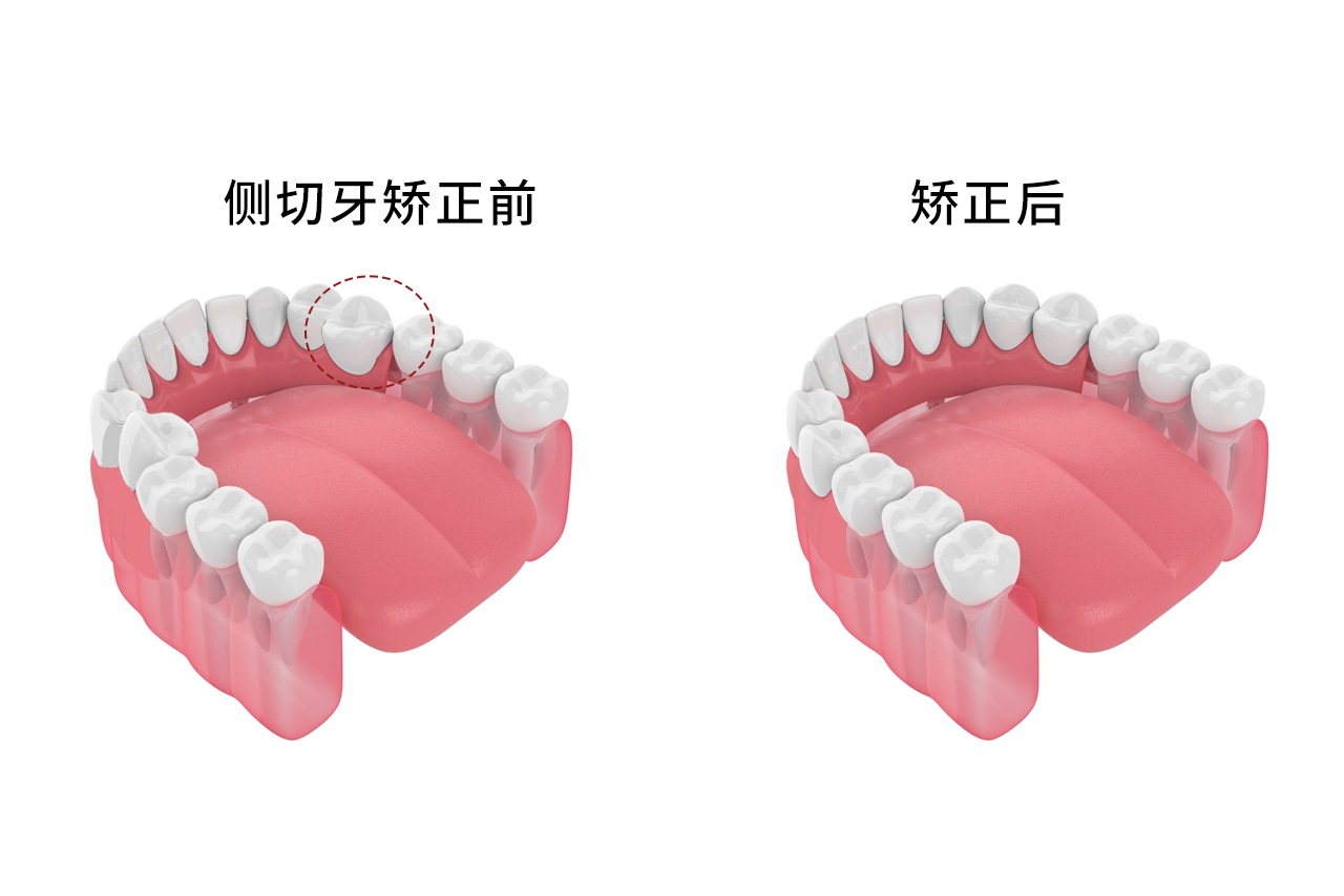 侧切牙小又尖纠正图片（侧切牙偏小）