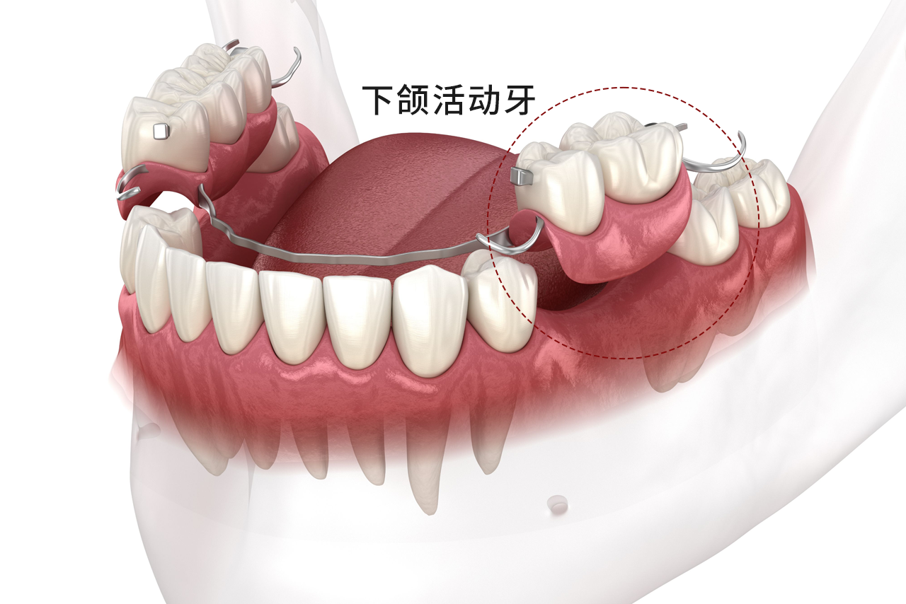 下颌活动牙图片 活动牙下牙图片