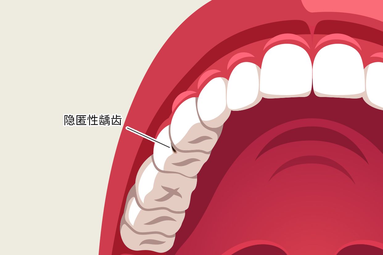 隐匿性龋齿图片 隐匿性龋齿图片