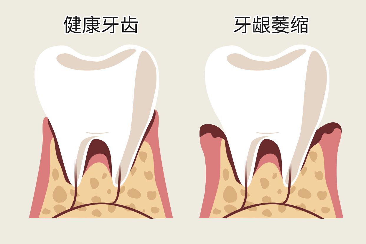 单个牙龈萎缩图片（单个牙龈萎缩图片）