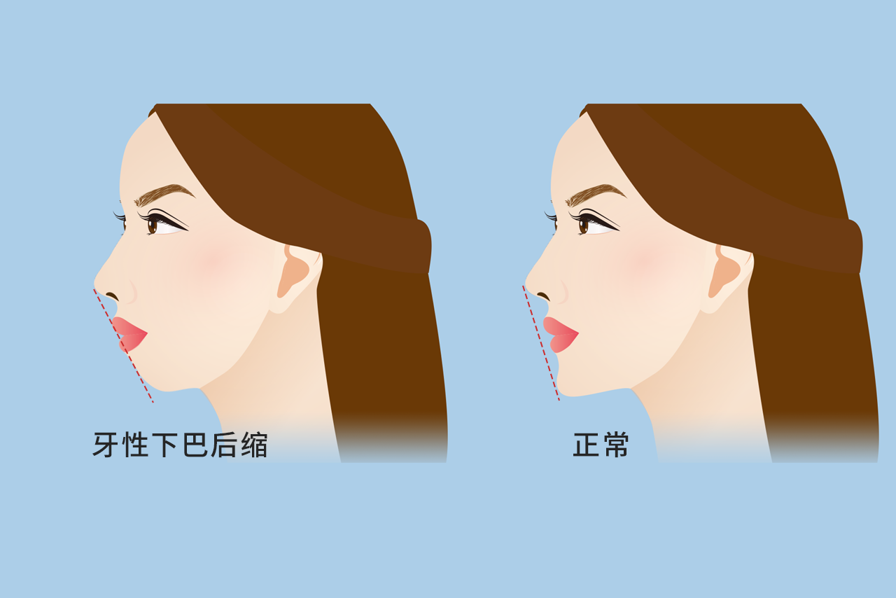 牙性下巴后缩图片 牙性下巴后缩和骨性下巴后缩