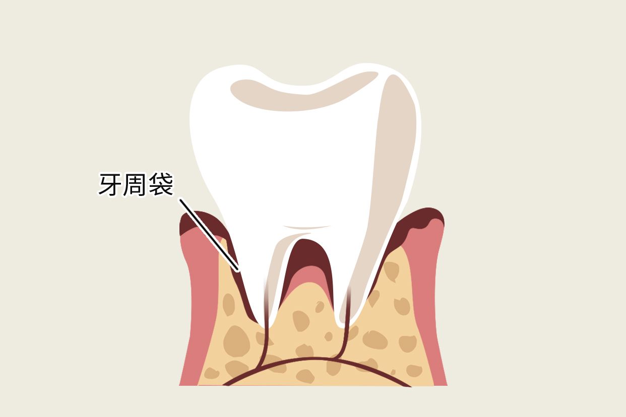 深牙周袋图片 牙周袋深度表