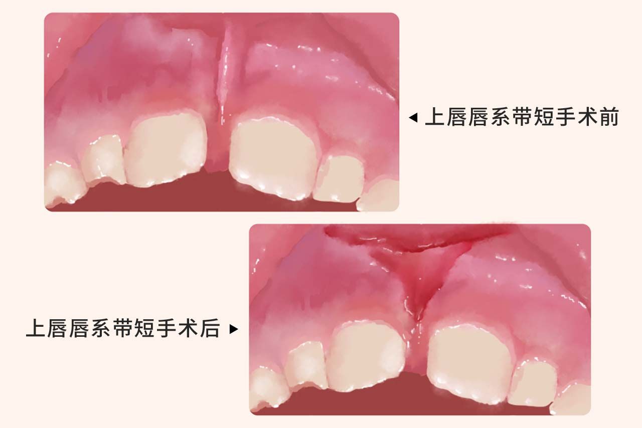 上唇唇系带短手术后图（唇系带短术前术后图片）