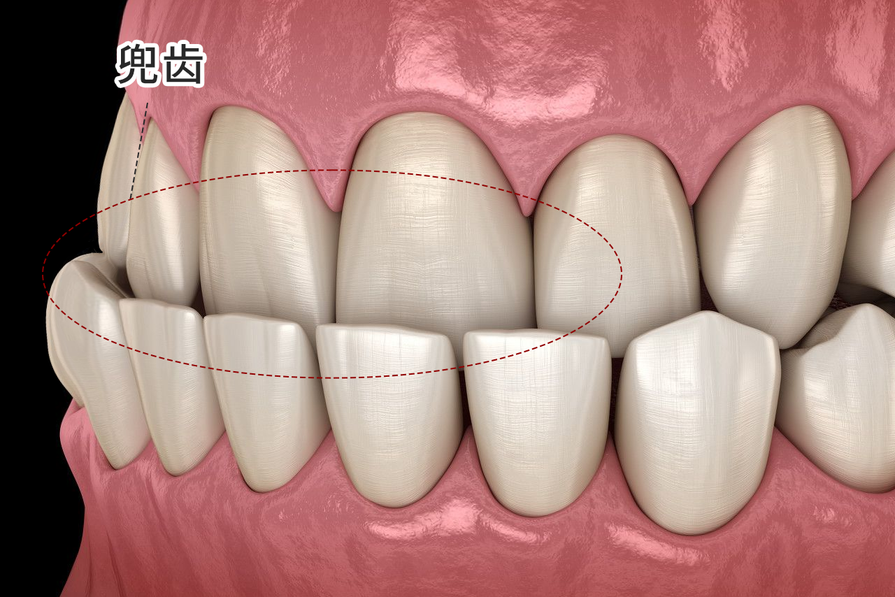 兜齿严重的照片 兜齿严重怎么办