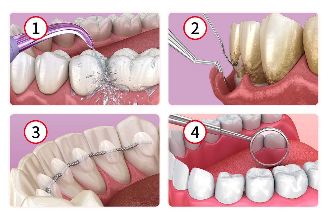 牙周治疗四个步骤图解（牙周的治疗方法）