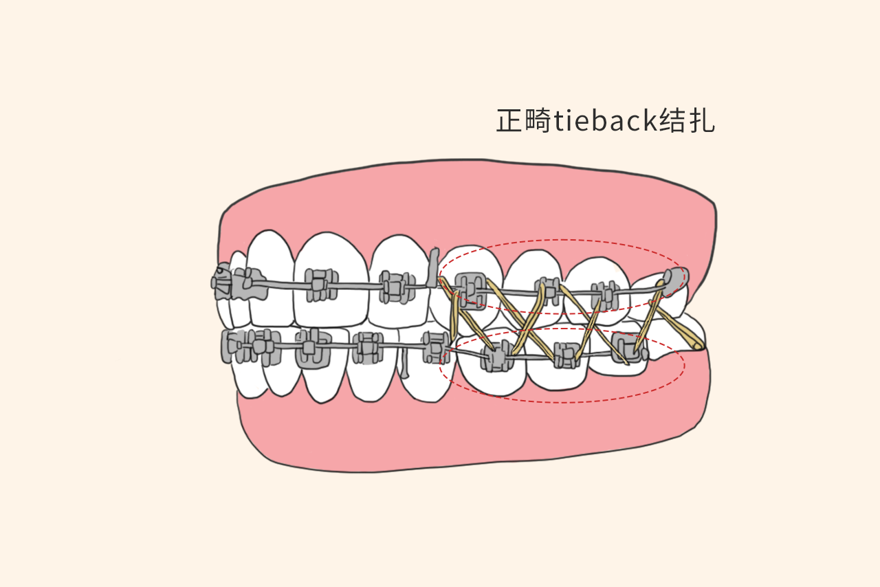 正畸tieback结扎图片（正畸支架图片）