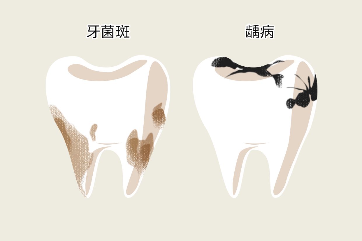 牙垢和蛀牙的区别图片（牙垢和蛀牙的区别图片对比）