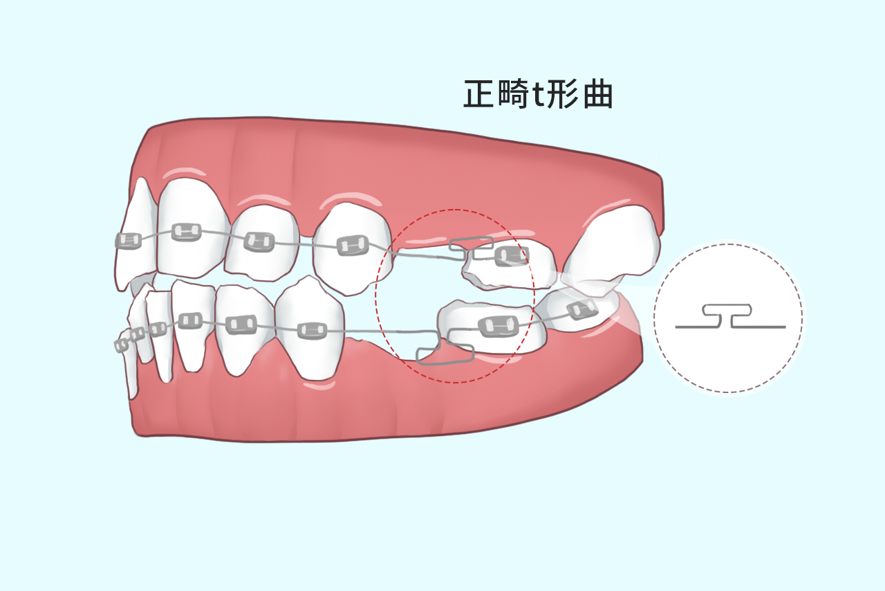 正畸t形曲的作用图解